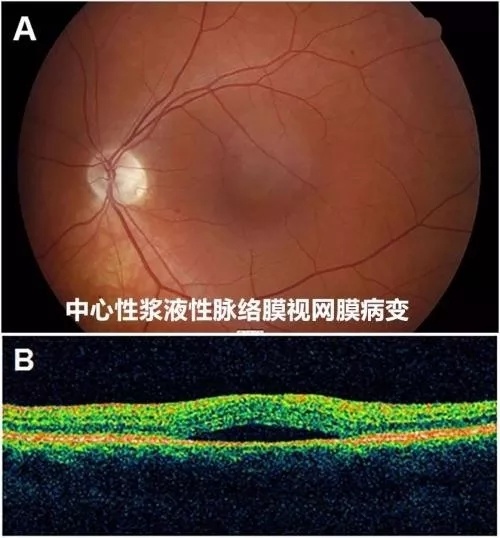 济宁爱尔眼科医院眼底病科普 认识常见眼底病 济宁门户网